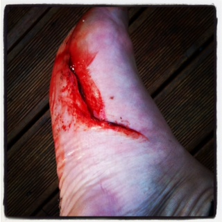 surfboard fin injury