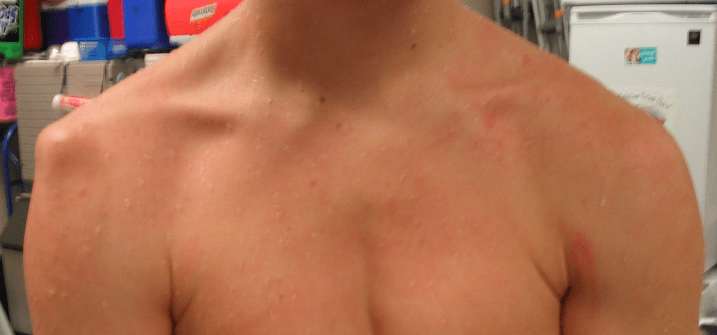 Shoulder dislocation surfing