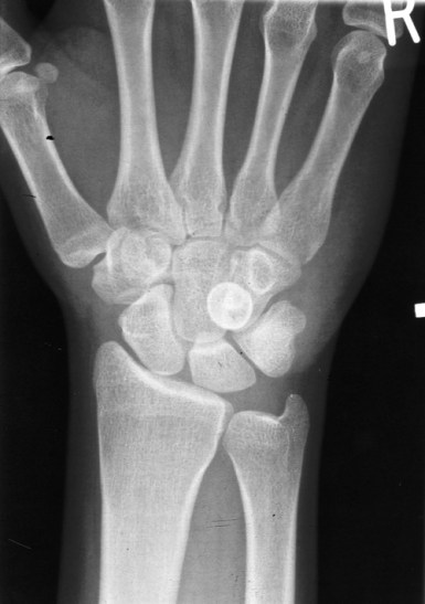 This guy presented to hospital with a surf wound that wasn't healing after 'cleaning' and suturing.